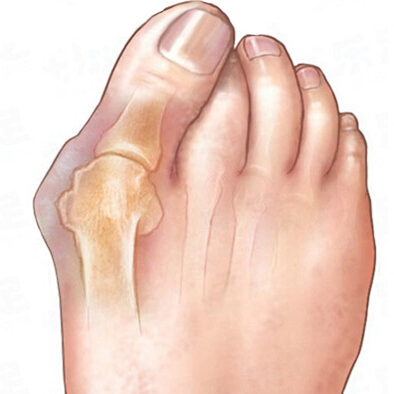 Silicone Bunion Corrector3.jpg